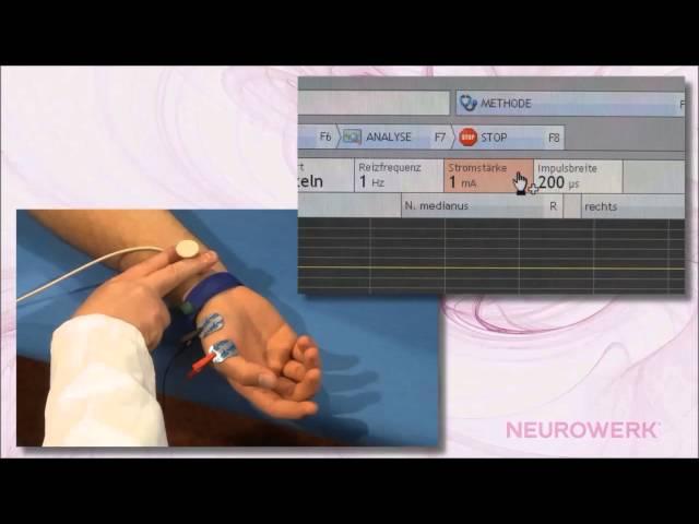 Motoric Neurography - Median Nerve