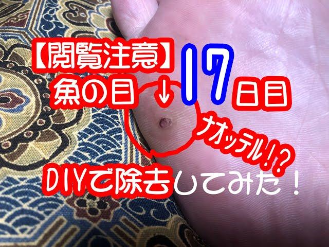 【閲覧注意】魚の目をDIYで除去する動画【17日目】