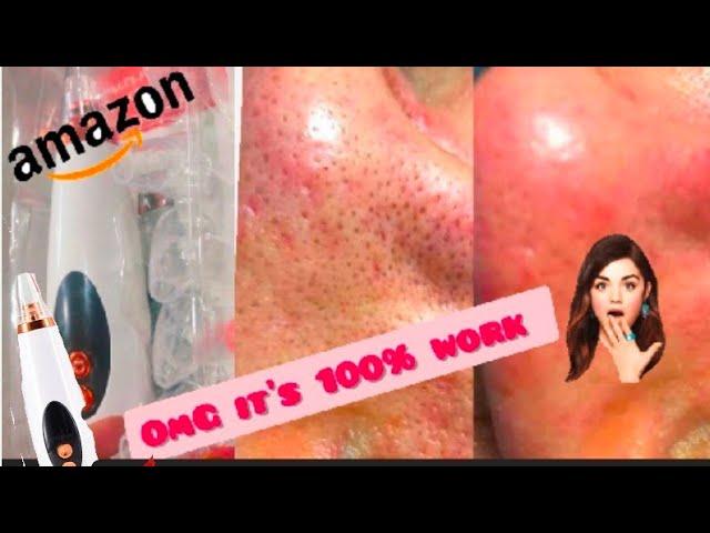 Black head remover device from Amazon | black head vacuum  work️ or not