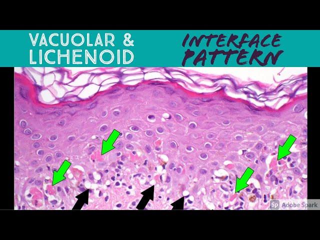 Vacuolar vs Lichenoid Interface Dermatitis Pattern - Inflammatory Dermpath Basics