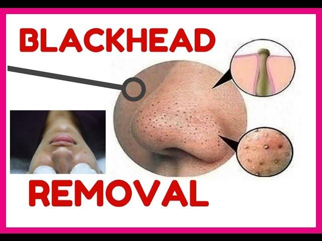 DIY Clear Skin Facial How to remove Blackheads Comedone Extraction Easy get rid unclog pores