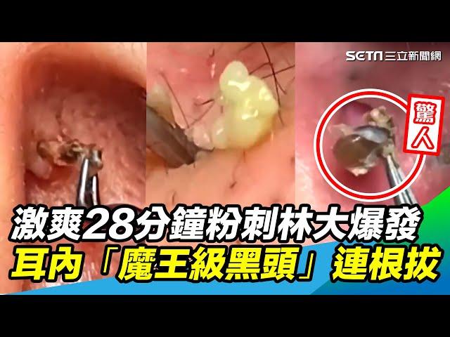 28分鐘激爽片！粉刺林、巨痘大爆發 耳內「魔王級黑頭」連根拔起｜@setn