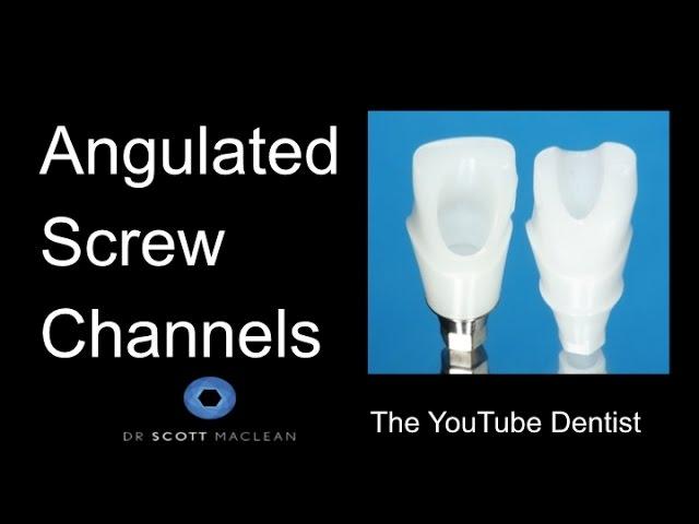 *New* Dental Implants - Angulated Screw Channels