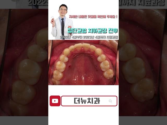 타 치과에서 4년 동안 교정 끝내지 못한 환자 #shorts #쇼츠