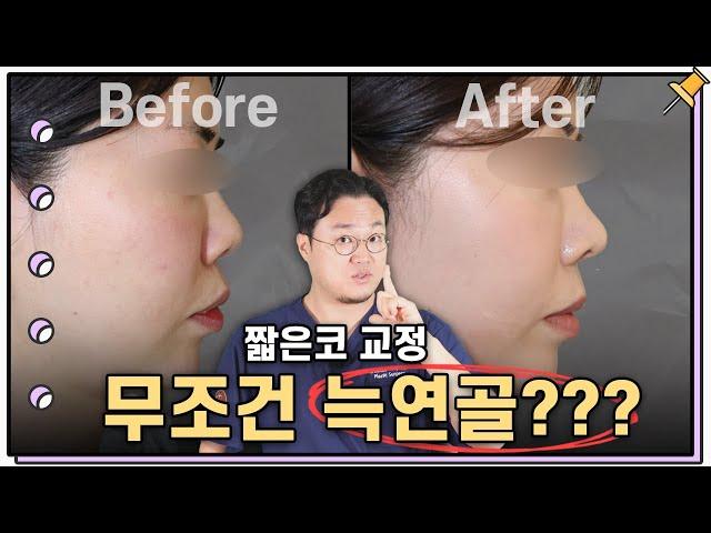 갈비연골(자가늑,기증늑) 없이도 짧은 코와 들창코를 교정하기 위해 확인해야만 하는 것