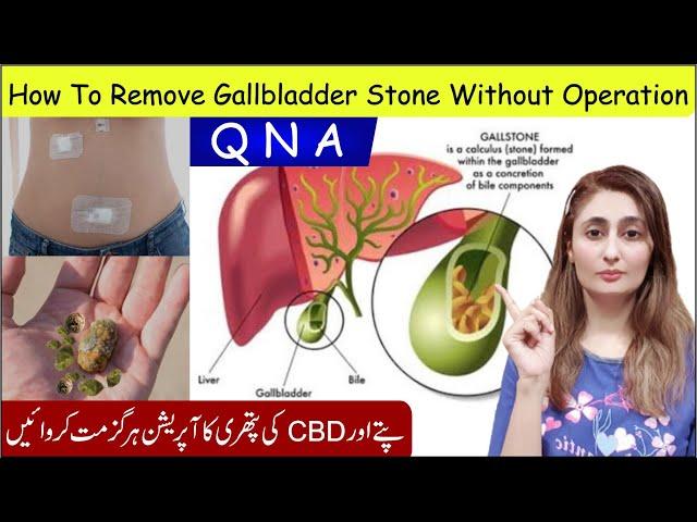 How To Remove Gallbladder Stone Q N A By Zunaira | Gallbladder Stones Treatment Without Operation?