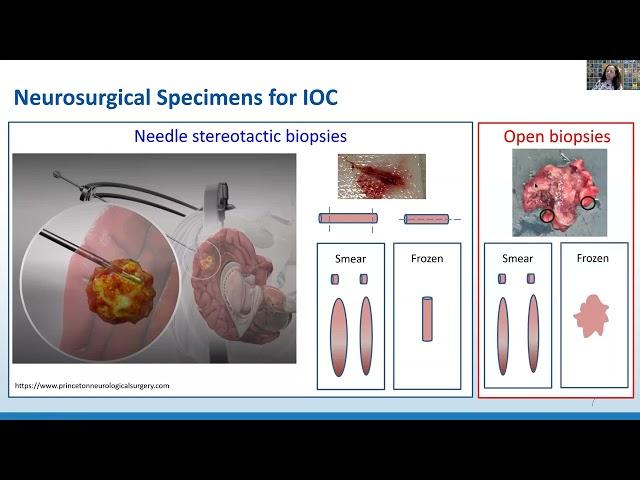 AANP Teaching Rounds - November 25, 2024 - Intraoperative Neuropathology