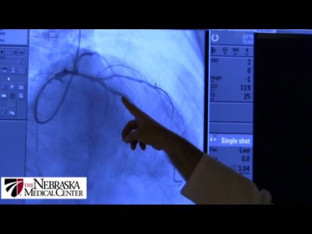 Coronary Stents - The Nebraska Medical Center