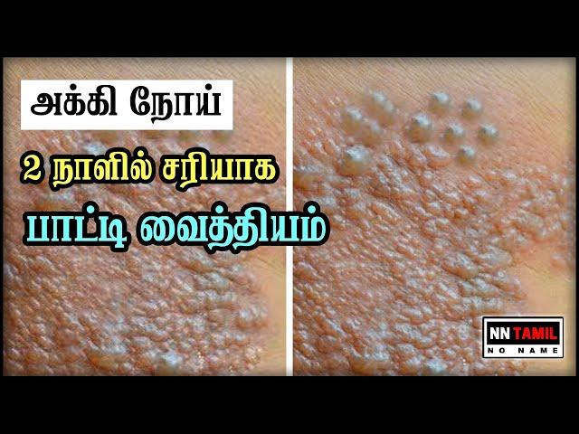 அக்கி வர காரணங்கள் மற்றும் சிகிச்சை முறை Akki Maraiya Paati Vaithiyam | NN Tamil