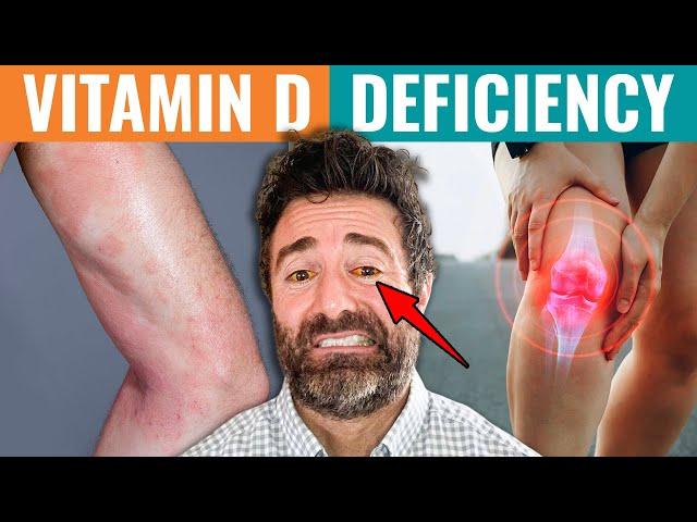 10 Signs You're Vitamin D Deficient (Vitamin D Deficiency Test )