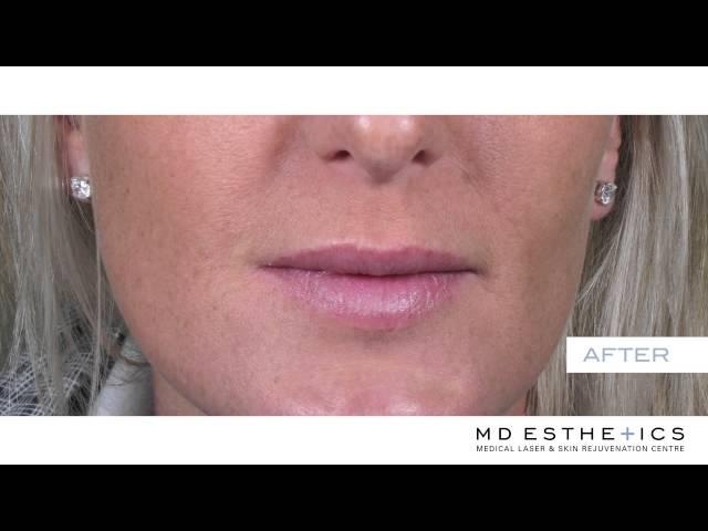 MD Esthetics Lips | Vancouver Video Production | Citrus Pie Media Group