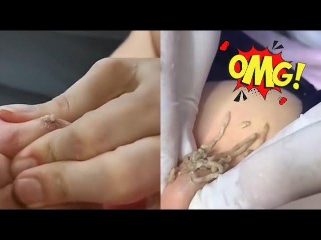 Ultimate Satisfying Acne & Blackhead Removal Compilation - Relax with Amazing Pimple Pops!