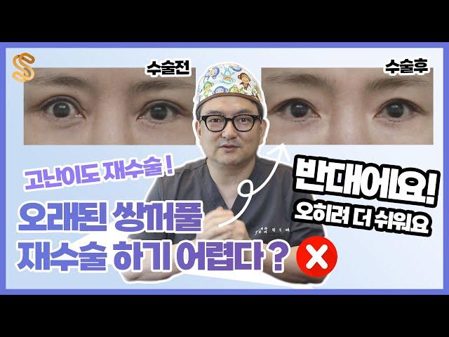 오래전에 망쳤던 쌍꺼풀수술 , 눈재수술 결과는 오히려 좋다 (고난이도 쌍꺼풀재수술 성공 사례)