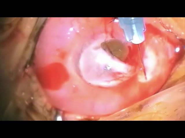 Hot corneoscleral graft. Dr AHMED Tawfik