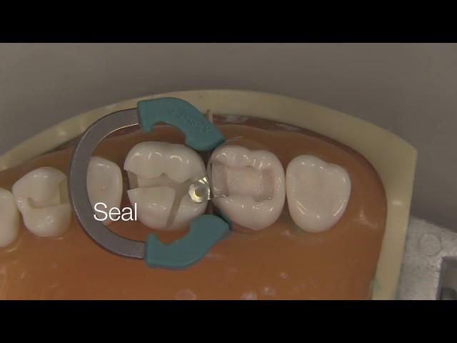 Class II Composite Restoration | Stevenson Dental Solutions