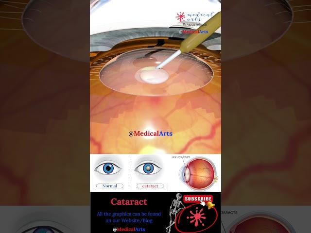 Cataract - Lens Implant - Medical Arts Shorts - 3d animation surgery