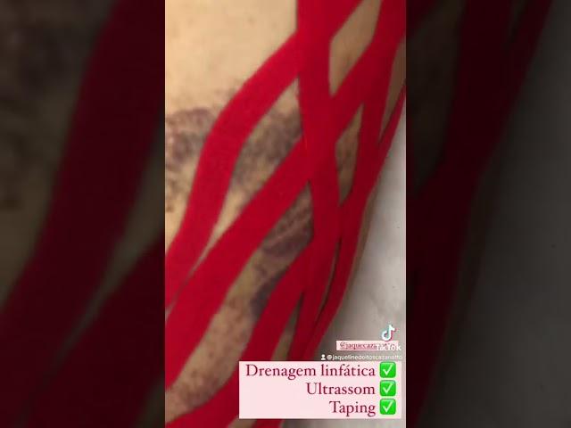 Taping para pós operatório