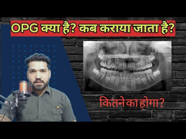 OPG / मुँह का बड़ा x-ray क्या होता है? कब कराया जाता है? कितने रूपए लगेंगे??