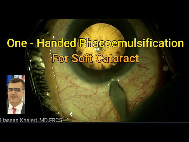 One - Handed phacoemulsification for Soft Cataract