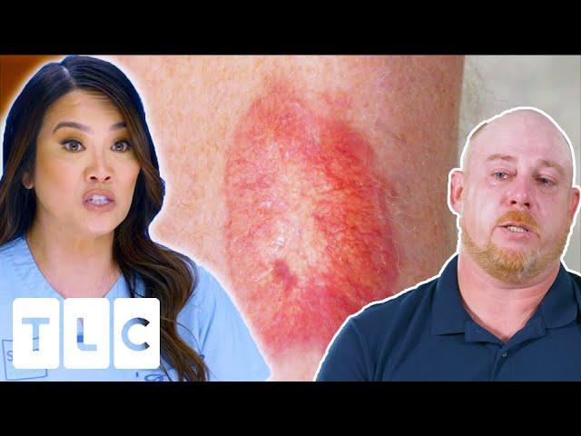 Unknown Red Patch On Man’s Leg Gets A Diagnosis After 12 Years | Dr Pimple Popper: This Is Zit