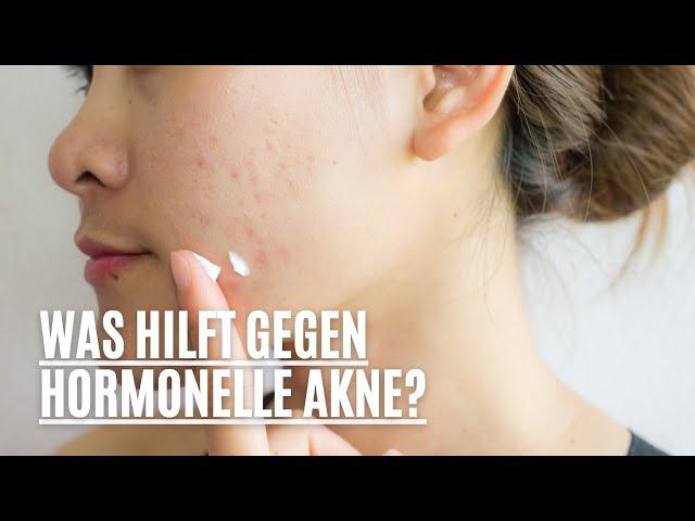 Was hilft gegen hormonelle Akne?