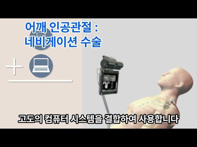 어깨 관절염과 관절 네비게이션 수술: 혁신의료의 미래 Shoulder Arthritis & Navigated Joint Replacement:The Innovative Future