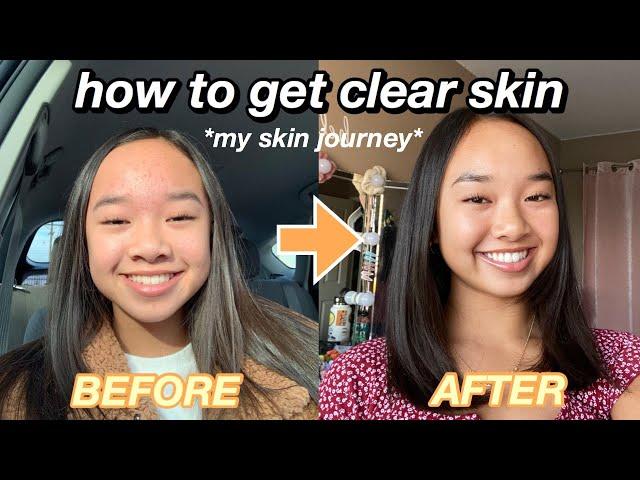 HOW TO GET CLEAR SKIN *my skin journey* | Nicole Laeno