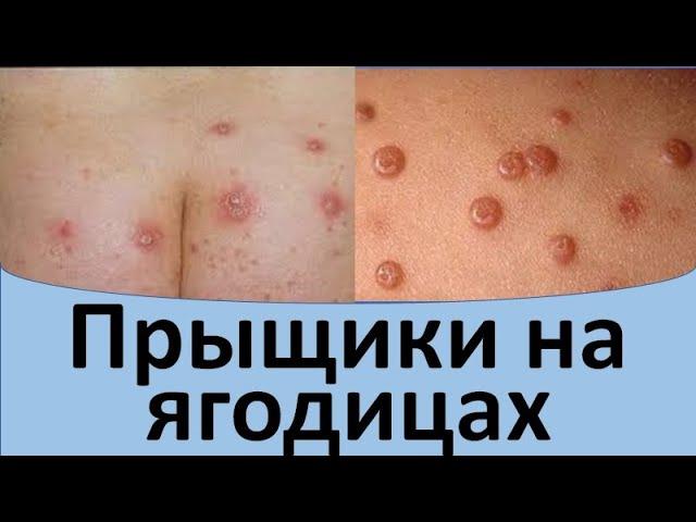 Прыщики на ягодицах