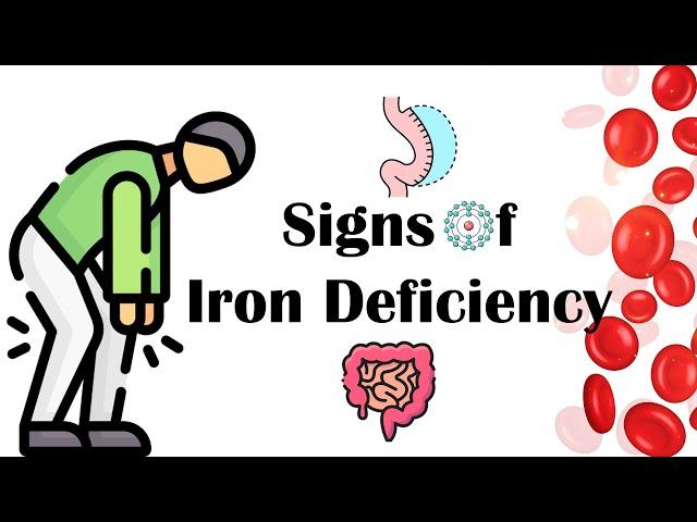 Signs Of Iron Deficiency |What Are The Signs & Symptoms Of Iron Deficiency Anemia (IDA)?