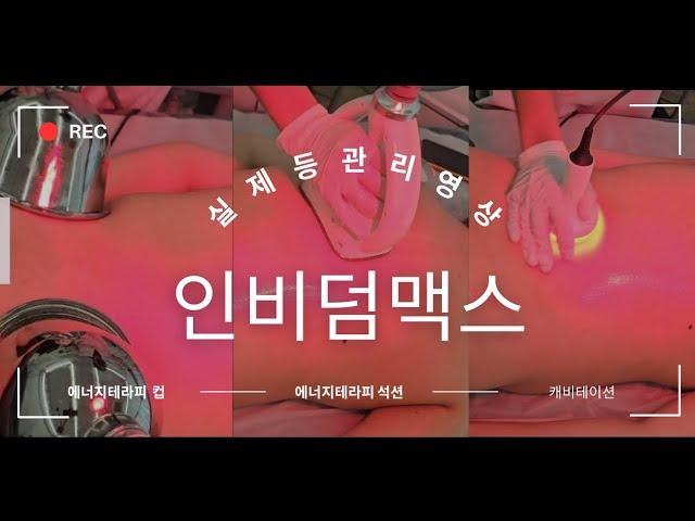 꿀잠연구소) 인비덤맥스 등관리 영상