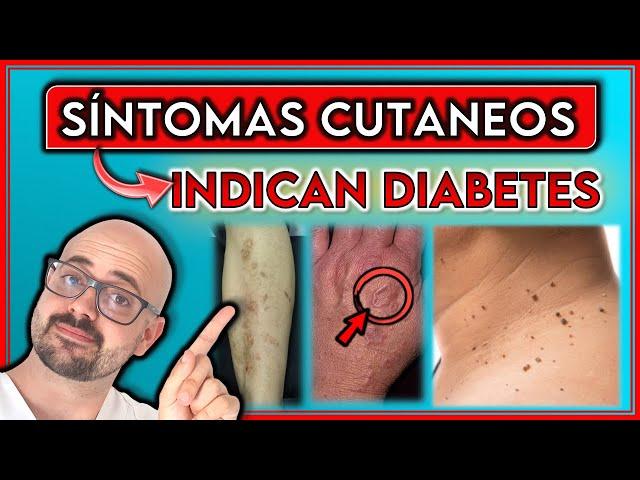 7 SEÑALES de la DIABETES que se manifiestan en la PIEL || ¡INDICAN una diabetes NO DETECTADA!