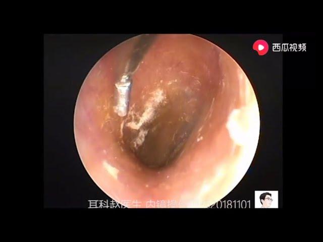 Treatment of fungus in external auditory canal, 11 minutes外耳道干片状真菌的处理