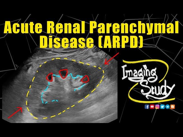 Acute Renal Parenchymal Disease || Ultrasound || Case 333