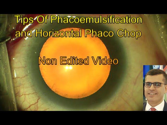 Tips of Phacoemulsification and Horizontal Phaco Chop , Non Edited Video.