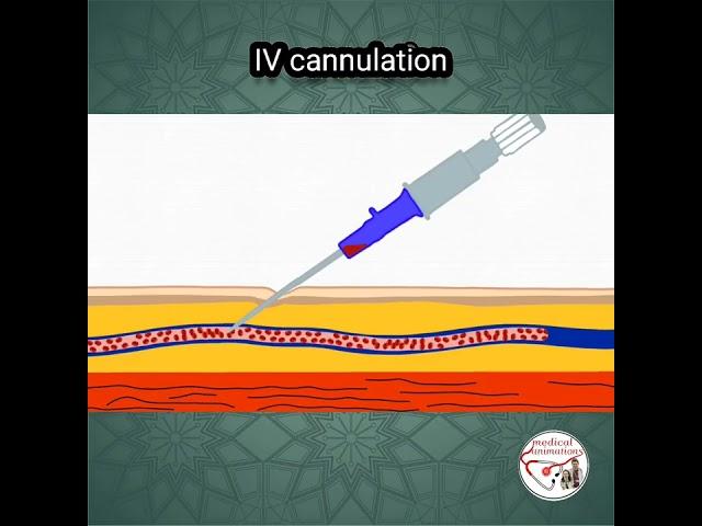  INTRAVENOUS (IV) CANNULATION ANIMATION