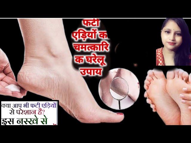 फटी एड़ियों को हमेशा के लिए ठीक करें(Home Remedies for Cracked Heel)