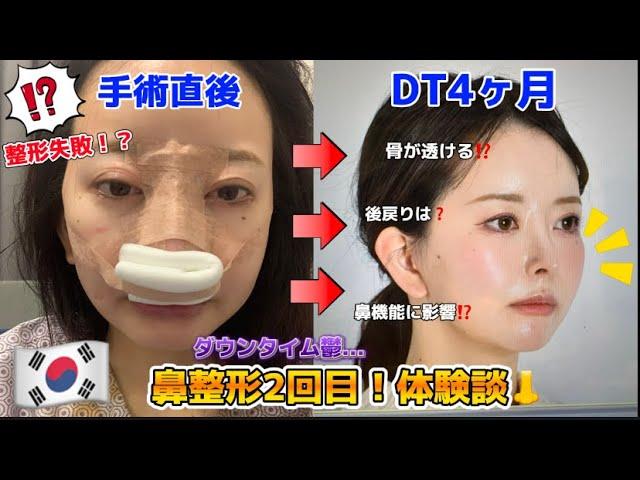 【鼻整形】整形失敗を覚悟した鼻整形2回目体験談#ダウンタイム #痛み