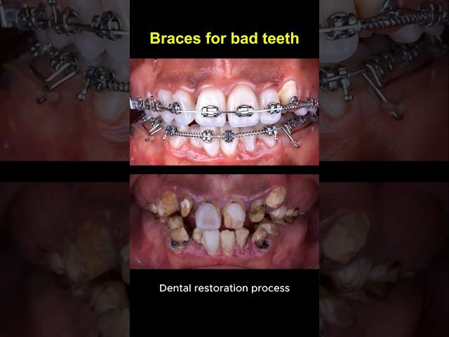 Restore bad teeth and braces #braces #orthodontist #dentist #teeth