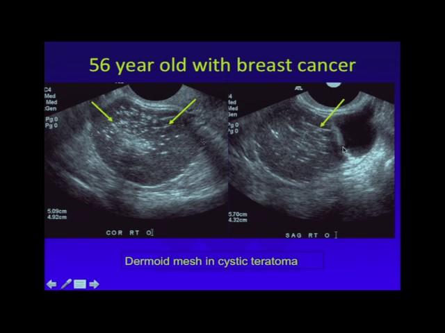 Ultrasound of Adnexal Masses