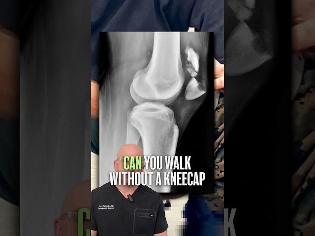 Why Doctors Say Keep Your Kneecap!