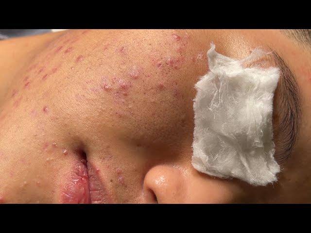 Blackheads & Whiteheads Removal New 2024 | Acne Treatment With  Bo Nguyễn Spa 033