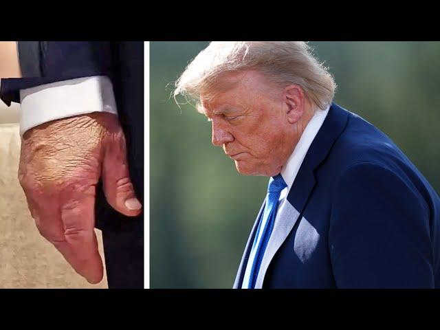 Trump health goes VIRAL over swollen, bruised hands