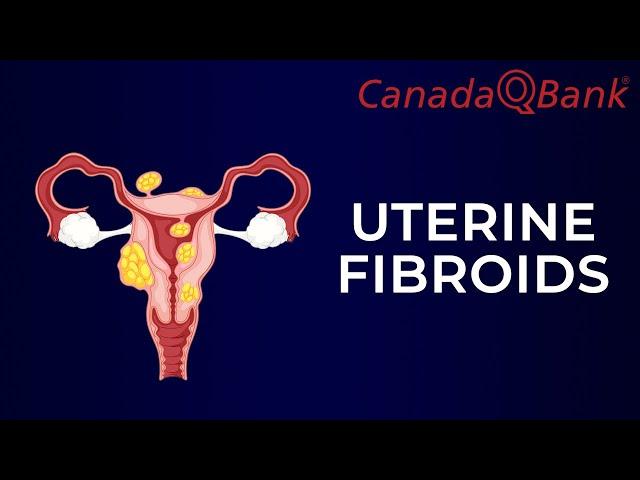 Uterine Fibroids