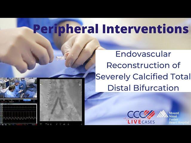 Watch Live Endovascular Reconstruction of Severely Calcified Total Distal Bifurcation