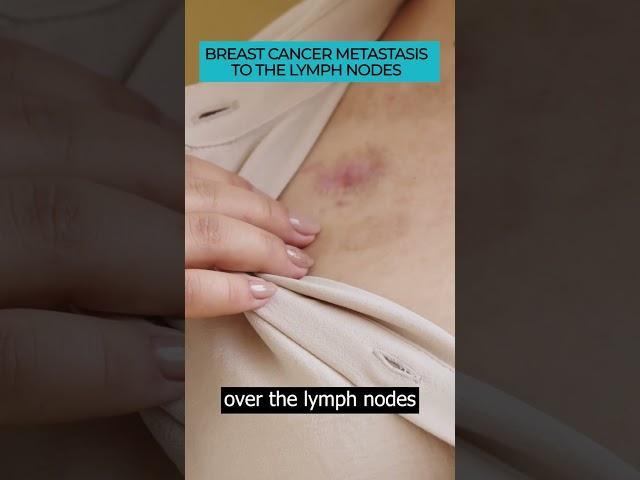 Spotting Symptoms of Breast Cancer Metastasis to Lymph Nodes ️#Cancer #Metastasis #cancerawareness