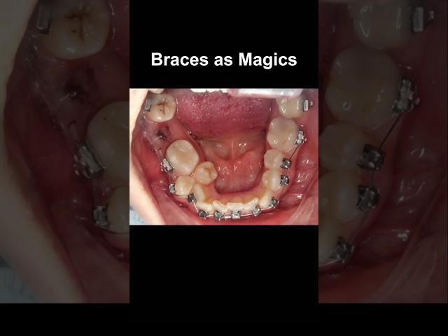 Braces as magics, fix all problem #braces #orthodontist #dentist #dentistry