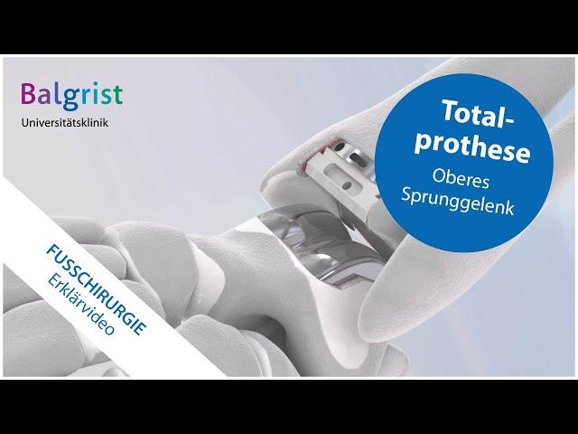 Totalprothese des oberen Sprunggelenks bei Arthrose