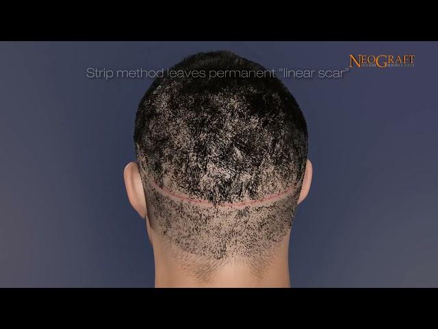 FUE Hair Transplant Overview - StudioMD