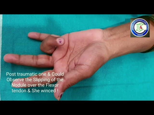 Trigger finger Examination | Ring finger Trigger | Adamya Hospital Videos