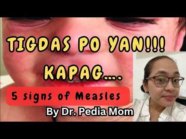 5 SIGNS may TIGDAS si baby| Symptoms of Measles in Children by Dr. Pedia Mom